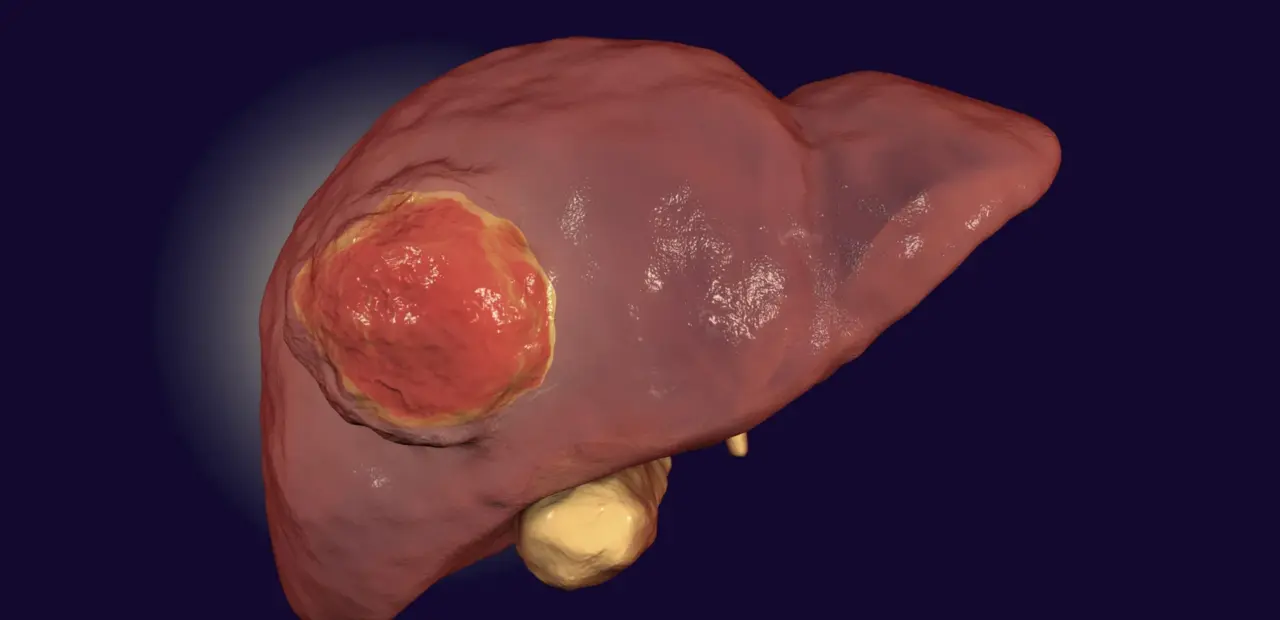 FDA-approved drug may help immunotherapy treat rare liver cancer