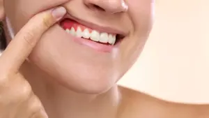 Jackfruit latex and pomegranate peel show promise for gum disease repair