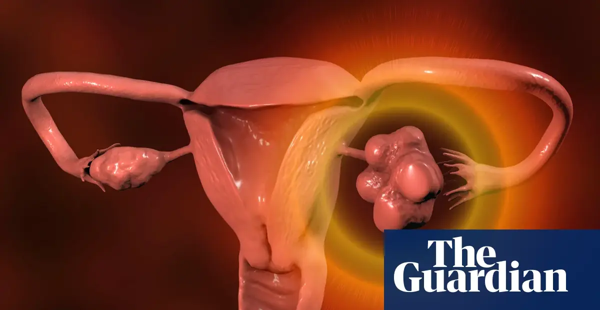 NHS advises checking irregular periods for PMOS