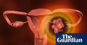 NHS advises checking irregular periods for PMOS