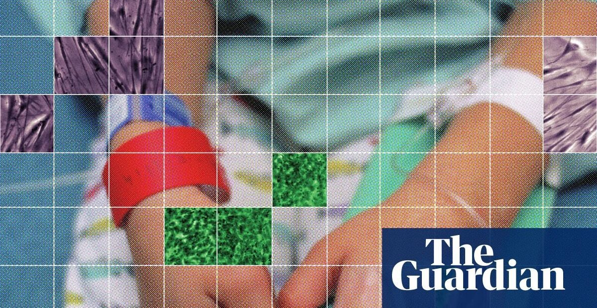 Unapproved stem cell treatments for autistic children grow in US