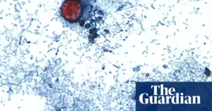 Cyclosporiasis outbreak spreads to 31 states, source investigation ongoing