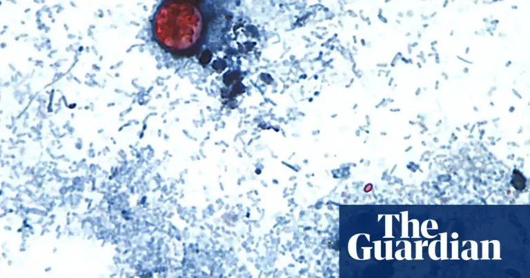 Cyclosporiasis outbreak spreads to 31 states, source investigation ongoing