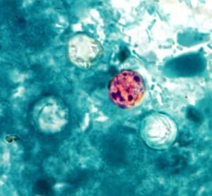 FDA and CDC Investigate New Cyclospora Outbreak With 72 Cases